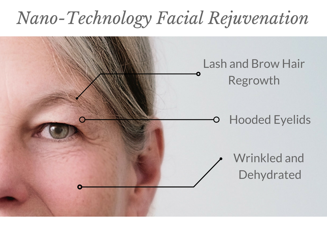 Nano Needling Technology